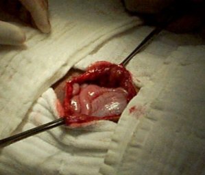 Redevet hernia2