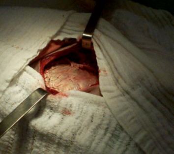 Redevet hernia3
