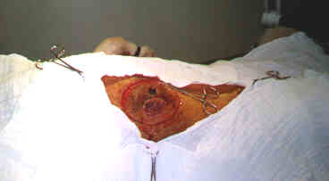 Redevet-tumor2